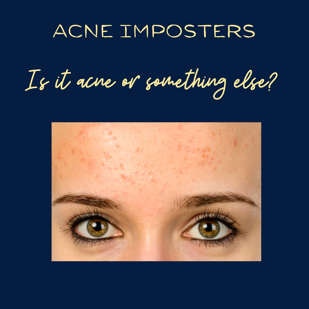 Acne Imposters! Is It Acne or Something Else?